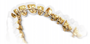 Incognito-lingual-braces
