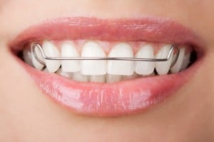 פלטה לשיניים - קיבוע בשיניים