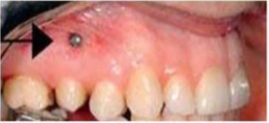 שתל אורתודונטי