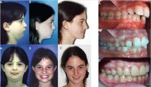 מנשך צידי של מטופלת המציגה תבנית גדילה לקויה של שלד הפנים