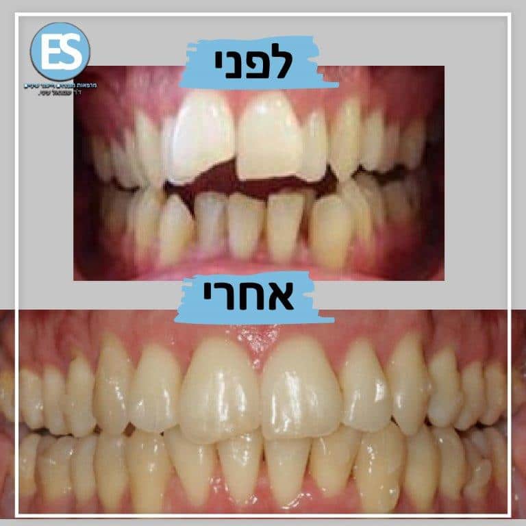 יישור שיניים ללא גשר למבוגרים לפני ואחרי