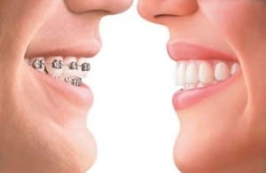 גשר לשיניים חשוב לדעת