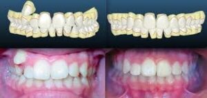 שיניים כלואות