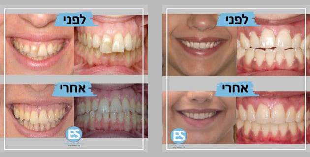 פער בין הלסתות