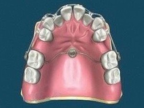חוסר שיניים מולד