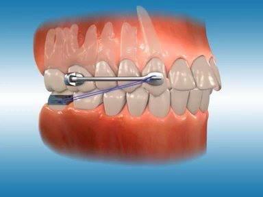 מכשור קרייר