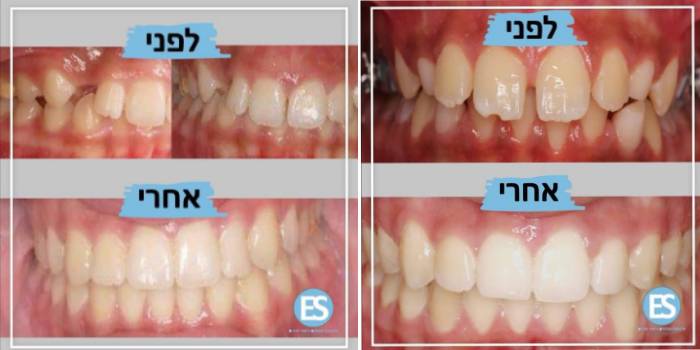 יישור שיניים אינויזליין