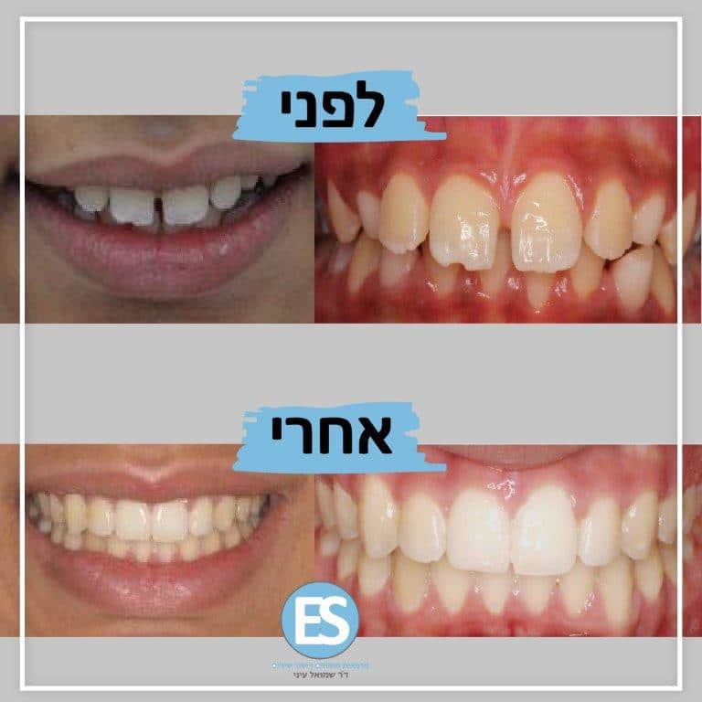 בת 12 יישור שיניים באמצעת גשר בשיניים