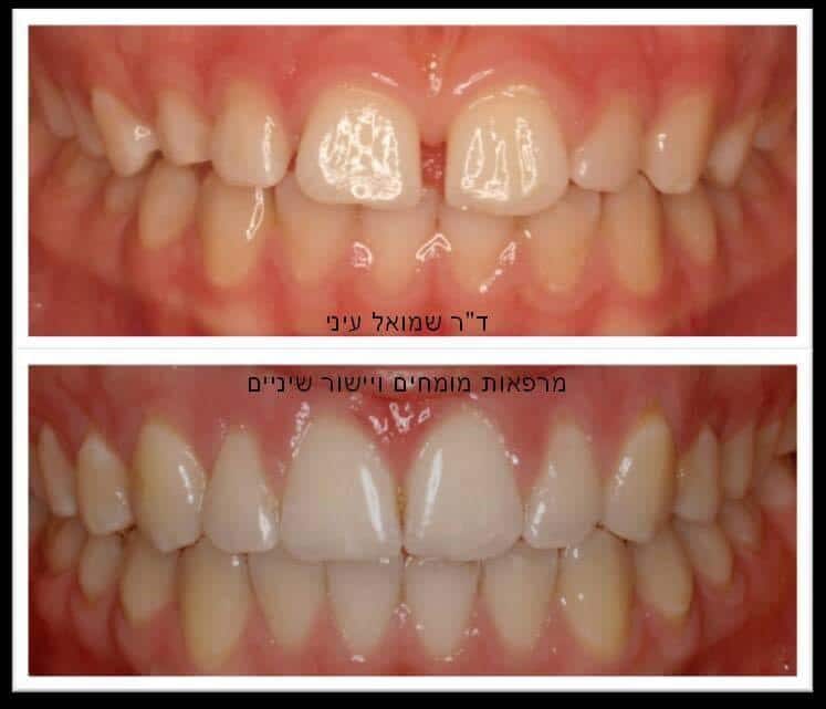 לפני ואחרי יישור שיניים - טיפול באמצעות גשר בשיניים
