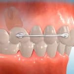 מכשור קרייר- יישור שיניים לילדים