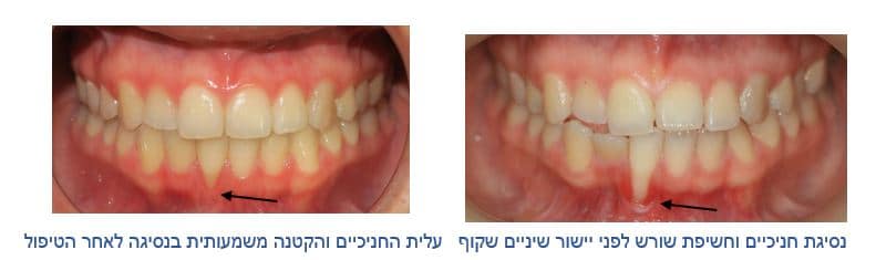 הקשר בין דלקות חניכיים לשינויים מבניים בשיניים ויישור שיניים