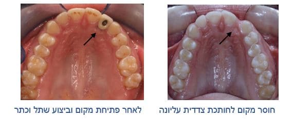 יישור שיניים לאחר דלקת בחניכיים