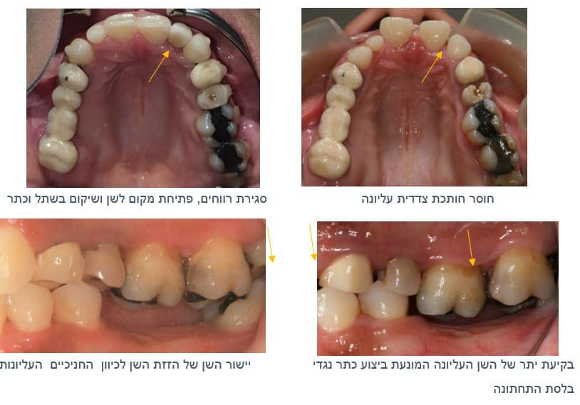 שיקום הפה ויישור השיניים