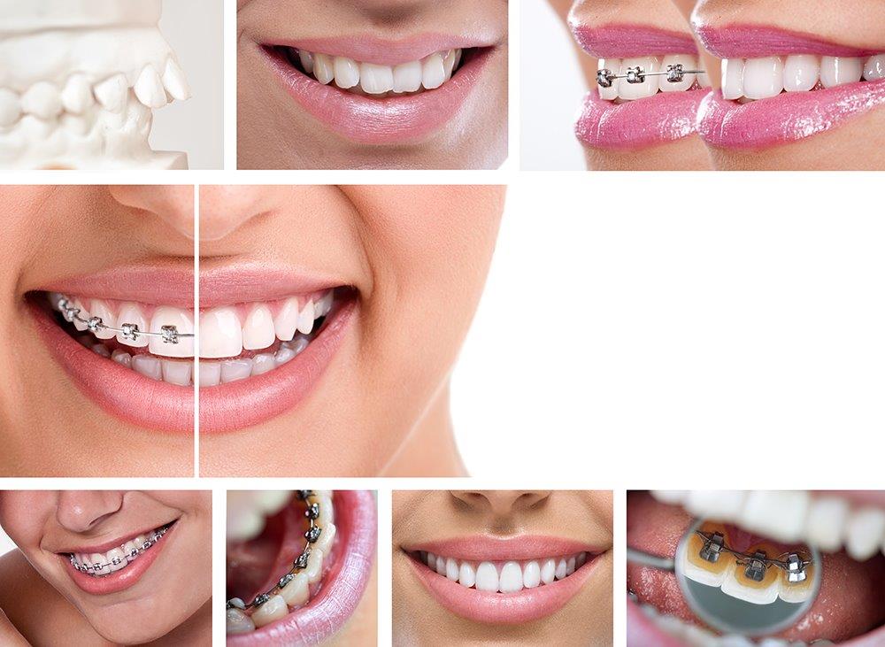 טיפולי שיניים שחייבים לעשות לפני הגיוס