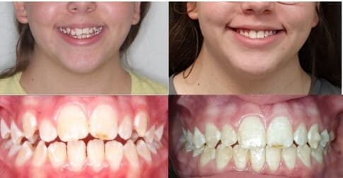 היפופלזיה בשיניים