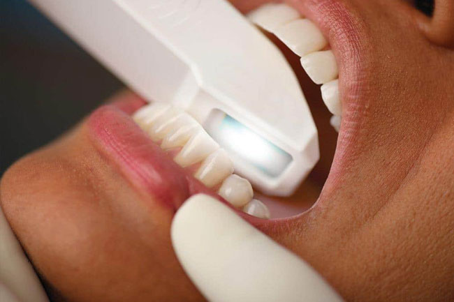 חידושים טכנולוגיים ביישור שיניים